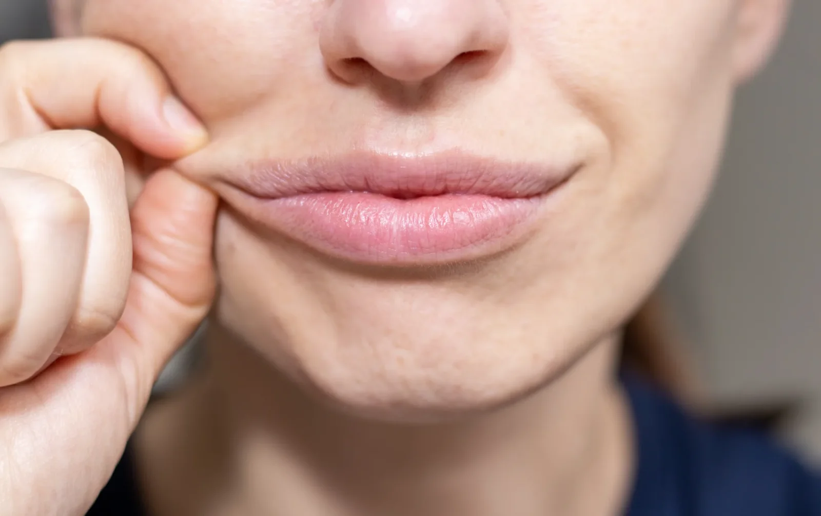 Lip Lift — Φυσική αναλογία, πιο εκφραστικό χαμόγελο.